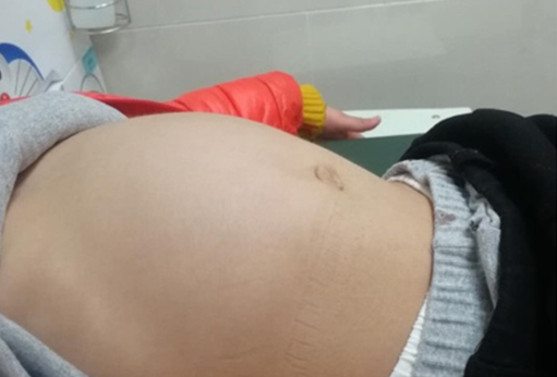 宁波5岁小女孩的胃扭转360°，医生说这个毛病罕见